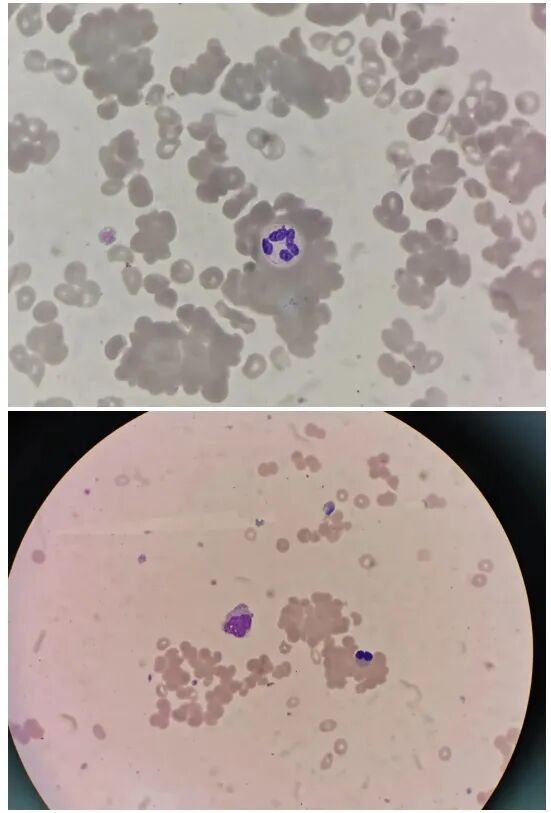 rbc直方图怎么看【安医科普】红细胞直方图解析_https://www.jmylbn.com_新闻资讯_第12张