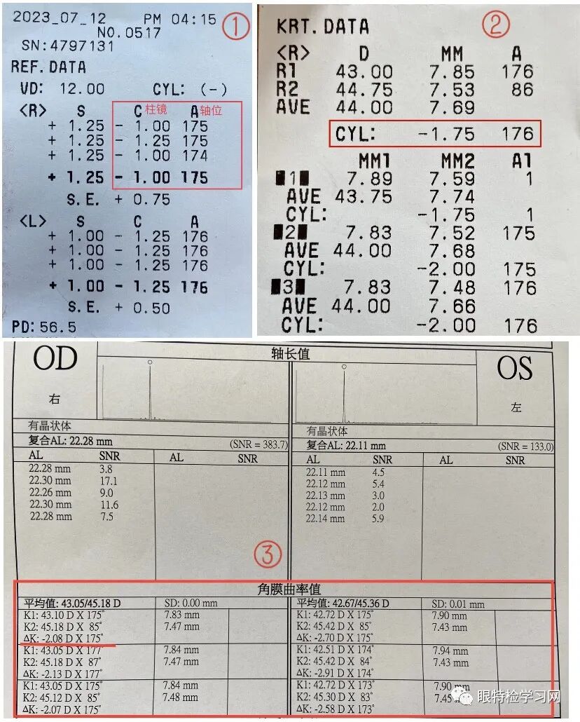 怎么测角膜直径【散光测量误差】——白内障术后残余散光形成原因_https://www.jmylbn.com_新闻资讯_第3张
