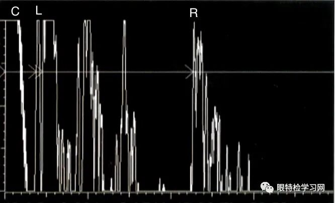 眼科a超报告单怎么看【A超】不同状态下的晶状体眼的A超声像图表现_https://www.jmylbn.com_新闻资讯_第7张
