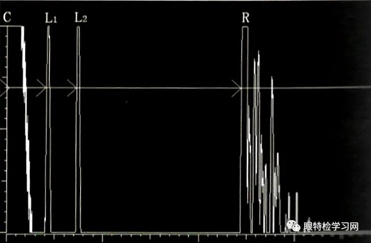 眼科a超报告单怎么看【A超】不同状态下的晶状体眼的A超声像图表现_https://www.jmylbn.com_新闻资讯_第3张
