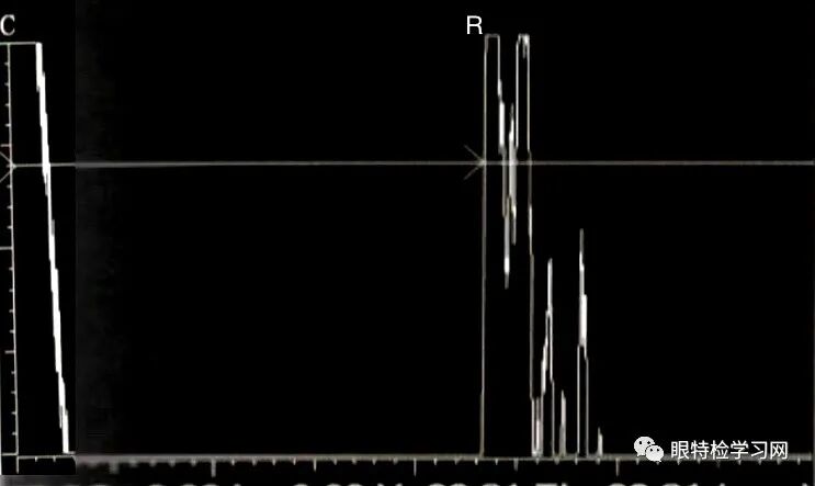 眼科a超报告单怎么看【A超】不同状态下的晶状体眼的A超声像图表现_https://www.jmylbn.com_新闻资讯_第5张