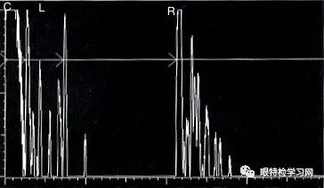 眼科a超报告单怎么看【A超】不同状态下的晶状体眼的A超声像图表现_https://www.jmylbn.com_新闻资讯_第9张