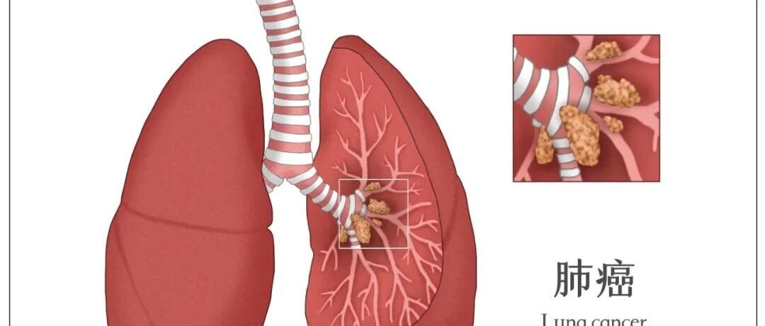肿瘤和癌症是一回事吗