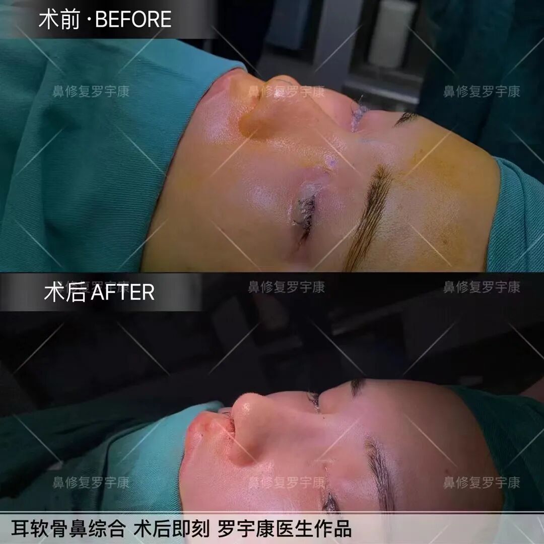 可吸收缝线怎么拆为什么明明有可吸收线，术后却还要回院拆线？_https://www.jmylbn.com_新闻资讯_第9张