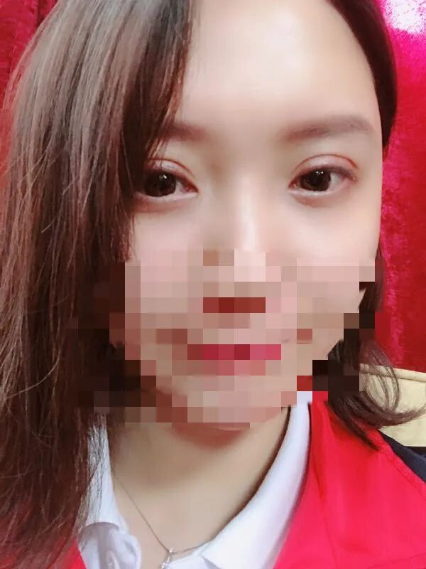 可吸收缝线怎么拆为什么明明有可吸收线，术后却还要回院拆线？_https://www.jmylbn.com_新闻资讯_第6张