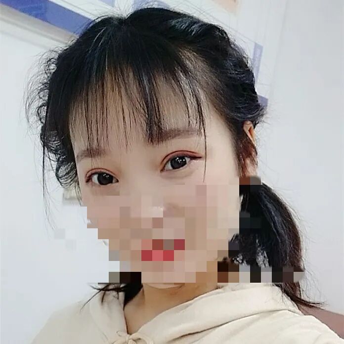 可吸收缝线怎么拆为什么明明有可吸收线，术后却还要回院拆线？_https://www.jmylbn.com_新闻资讯_第5张