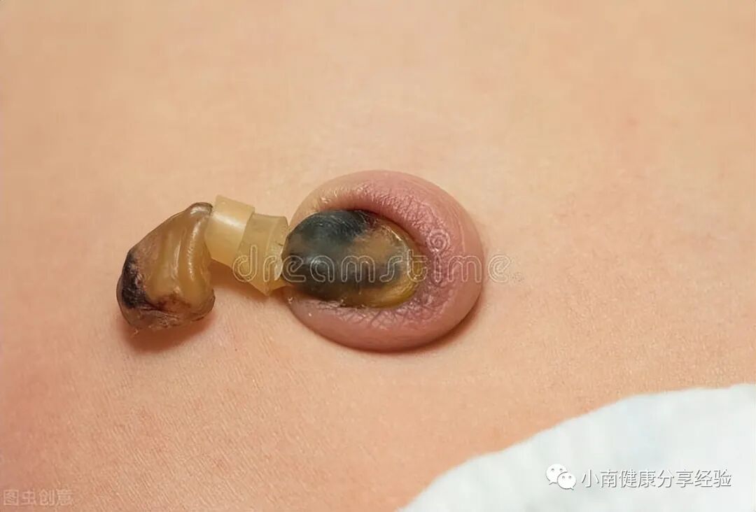 为什么剪脐带要先夹住剪脐带是妈妈疼还是宝宝疼？脐带出现这些异常，说明要去医院看看_https://www.jmylbn.com_新闻资讯_第5张