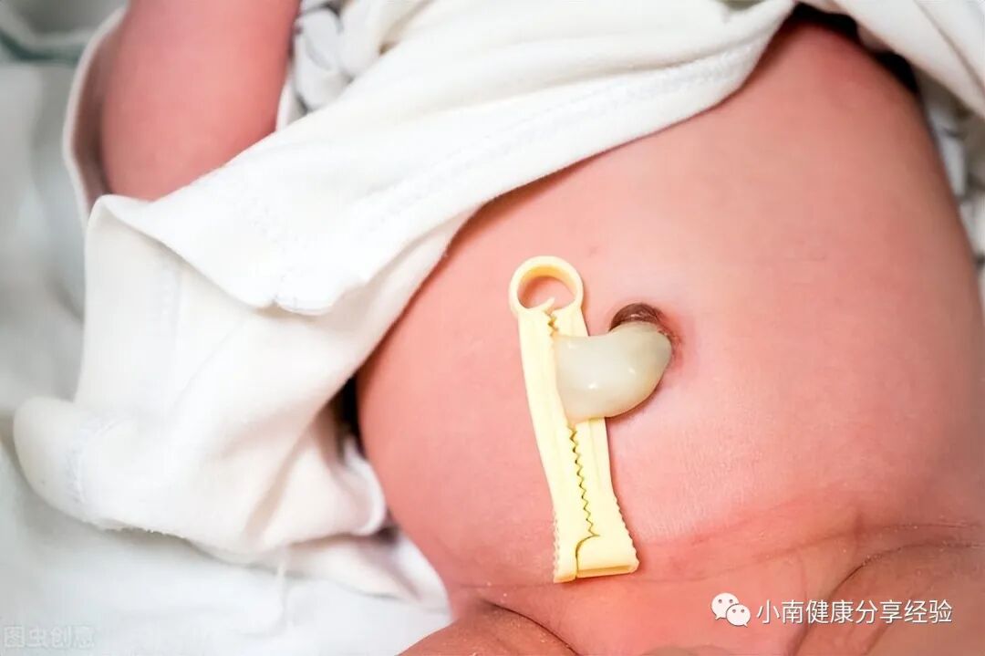 为什么剪脐带要先夹住剪脐带是妈妈疼还是宝宝疼？脐带出现这些异常，说明要去医院看看_https://www.jmylbn.com_新闻资讯_第1张