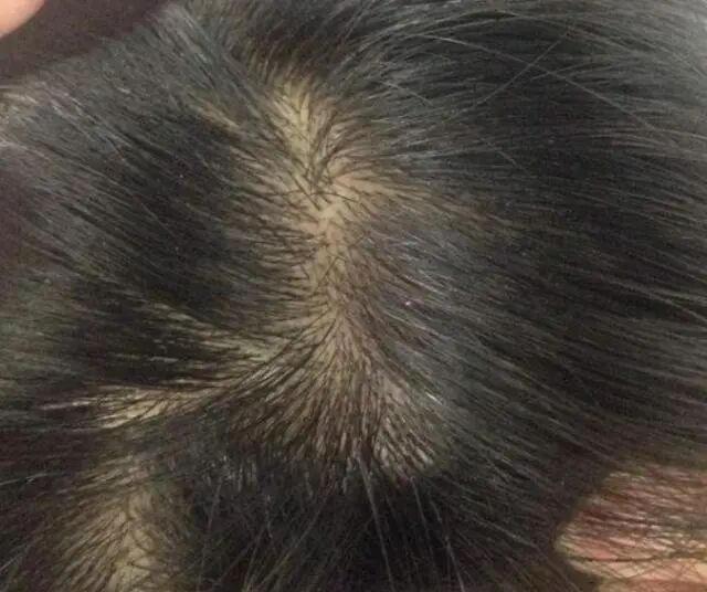 点痣后结痂掉了又结痂_头皮结痂又抠掉又结痂怎么治_疤痕性体质抠了结痂