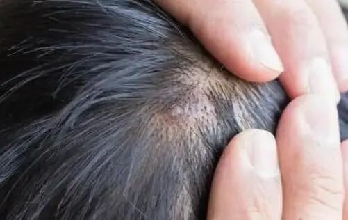 点痣后结痂掉了又结痂_头皮结痂又抠掉又结痂怎么治_疤痕性体质抠了结痂