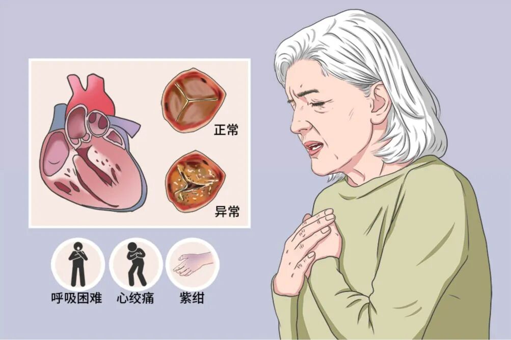 动态心电图仪器怎么看一文了解24小时动态心电图_https://www.jmylbn.com_新闻资讯_第6张