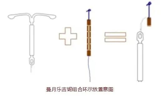曼月乐环加强版-吉曼环来袭，让大子宫上环也无忧！