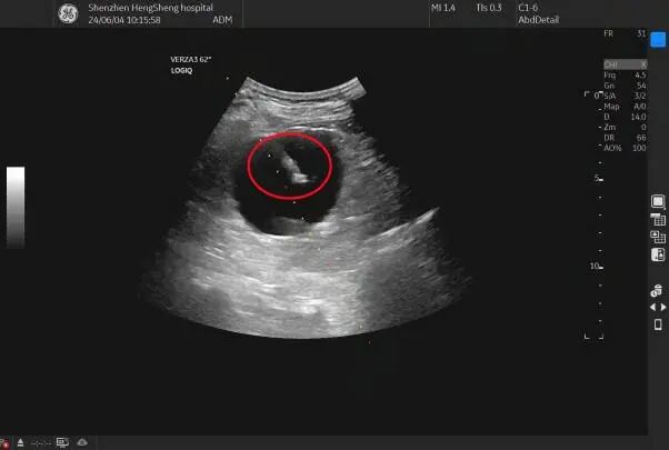 于是建议黄大爷做创伤小,疗效好的超声引导下右肾囊肿穿刺抽液 聚桂醇