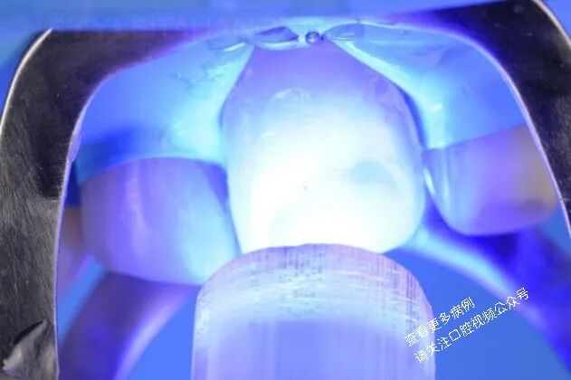 贴面粘接流程：从酸蚀到抛光全步骤（28图详解）