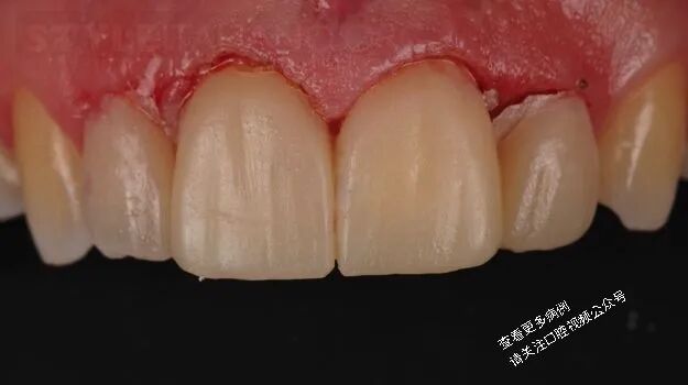 贴面粘接流程：从酸蚀到抛光全步骤（28图详解）