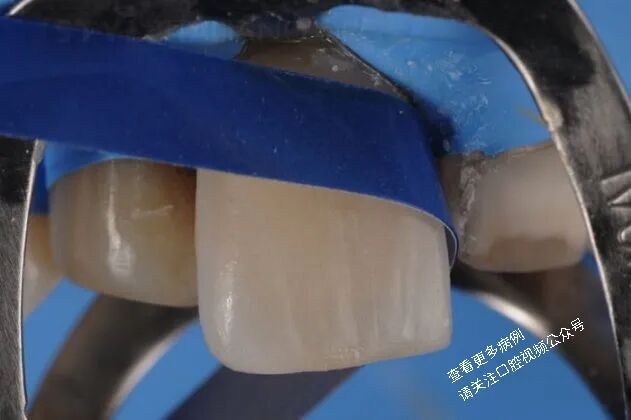 贴面粘接流程：从酸蚀到抛光全步骤（28图详解）