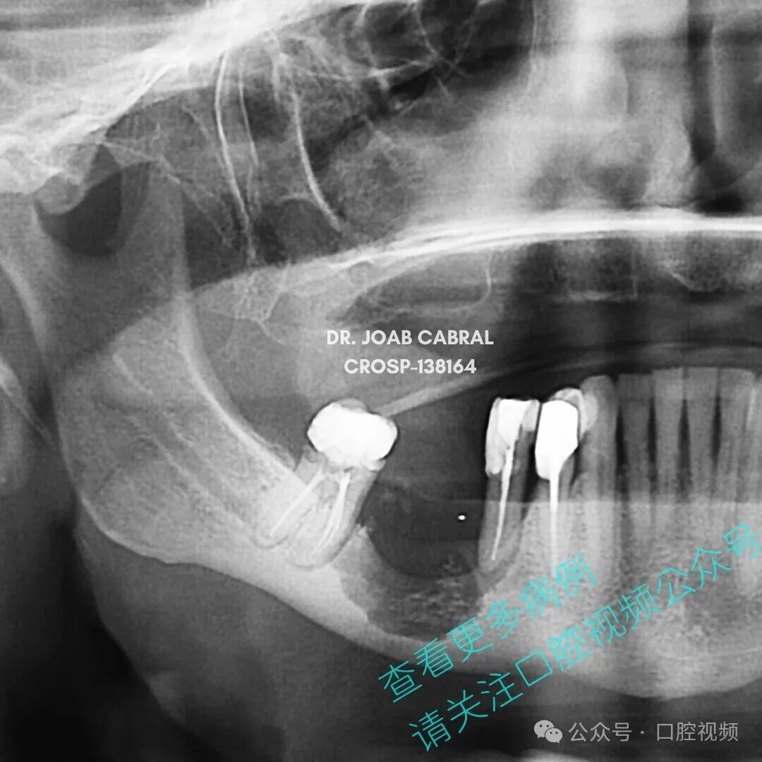 服阿仑膦酸钠患者颌骨坏死，拔牙后骨暴露，18个月治疗随访