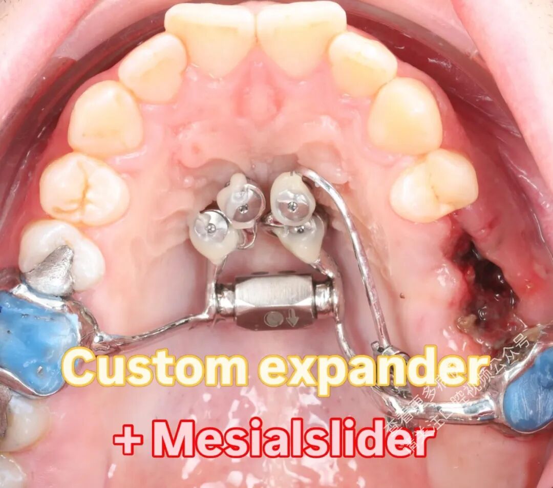 这样的正畸操作，你见过吗