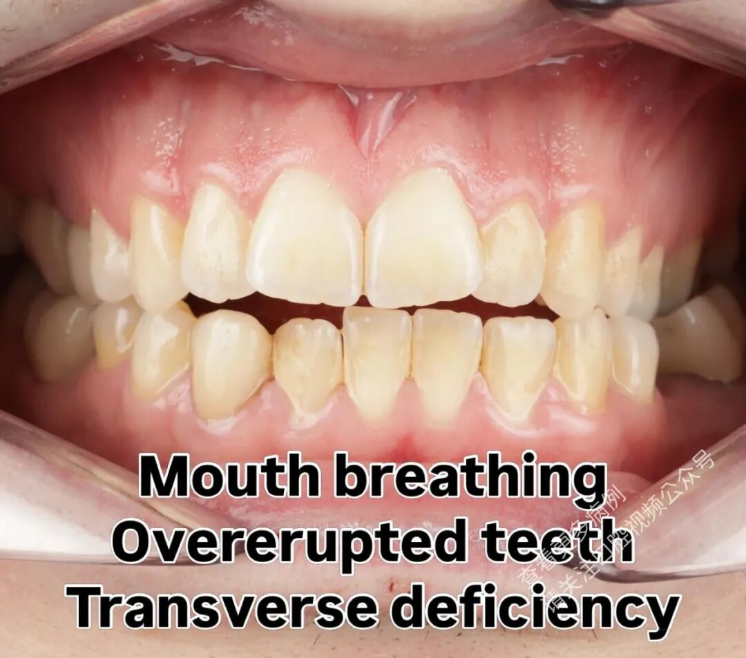 这样的正畸操作，你见过吗