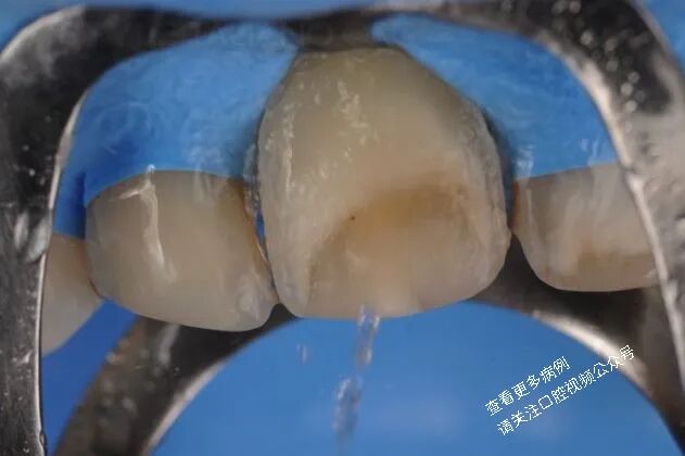 贴面粘接流程：从酸蚀到抛光全步骤（28图详解）