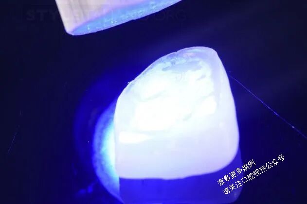 贴面粘接流程：从酸蚀到抛光全步骤（28图详解）