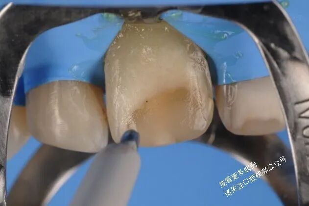 贴面粘接流程：从酸蚀到抛光全步骤（28图详解）