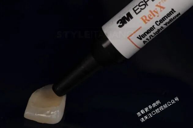 贴面粘接流程：从酸蚀到抛光全步骤（28图详解）