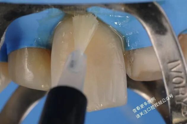 贴面粘接流程：从酸蚀到抛光全步骤（28图详解）