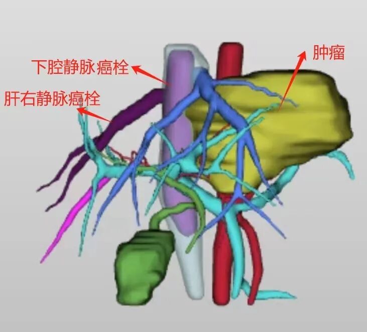 「微医讯」三维重建复杂肿瘤,多学科团队成功救治2岁幼儿