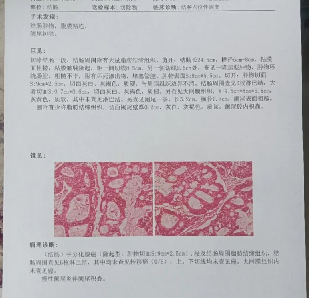结肠灌洗怎么回事巨野县中医医院外一科成功实施急诊术中结肠灌洗Ⅰ期结肠吻合术，真正为肠梗阻患者“解困”_https://www.jmylbn.com_新闻资讯_第4张