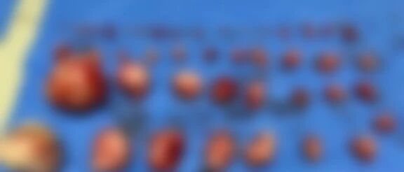 贵阳女子突然尿频尿急！医生从她肚子里取出40多坨这个……最大的如拳头