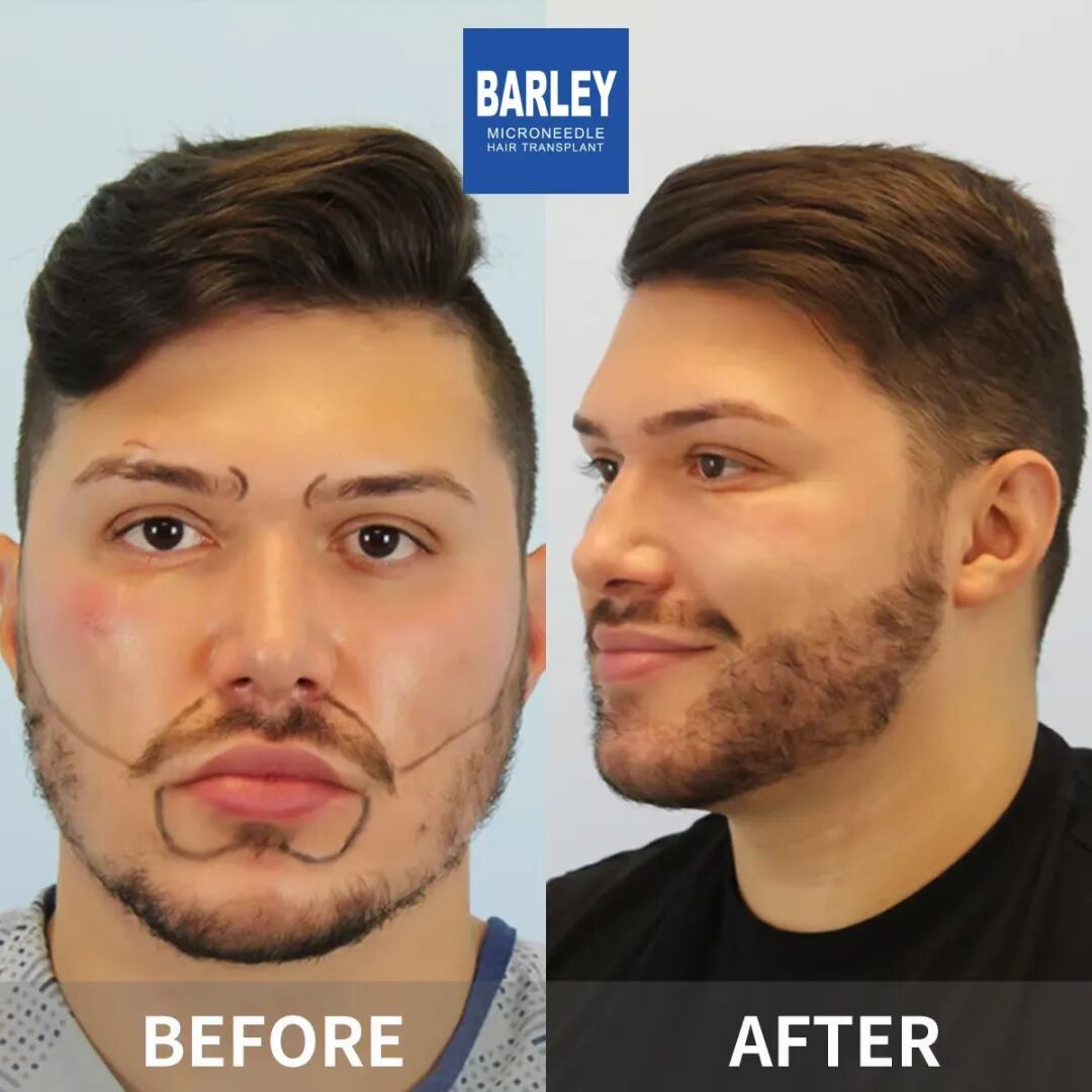 Mid-Autumn & National Day Hair Transplant Deal ： Barley Microneedle, No Shave