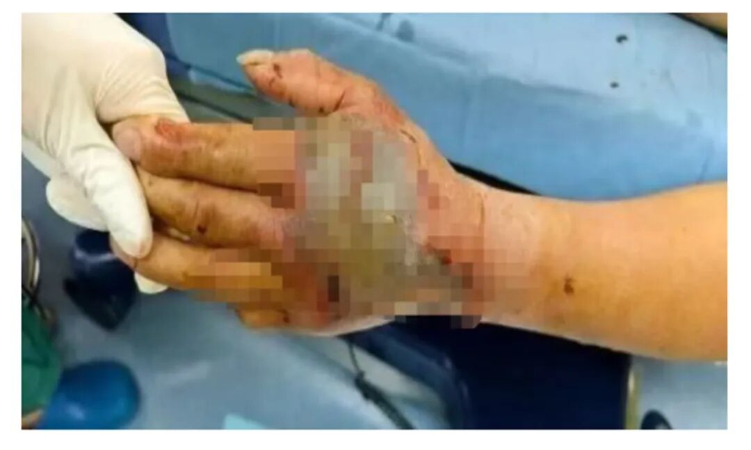 Severed Cobra Head Bites 72-Year-Old Man 5 Minutes After Decapitation in Zhejiang