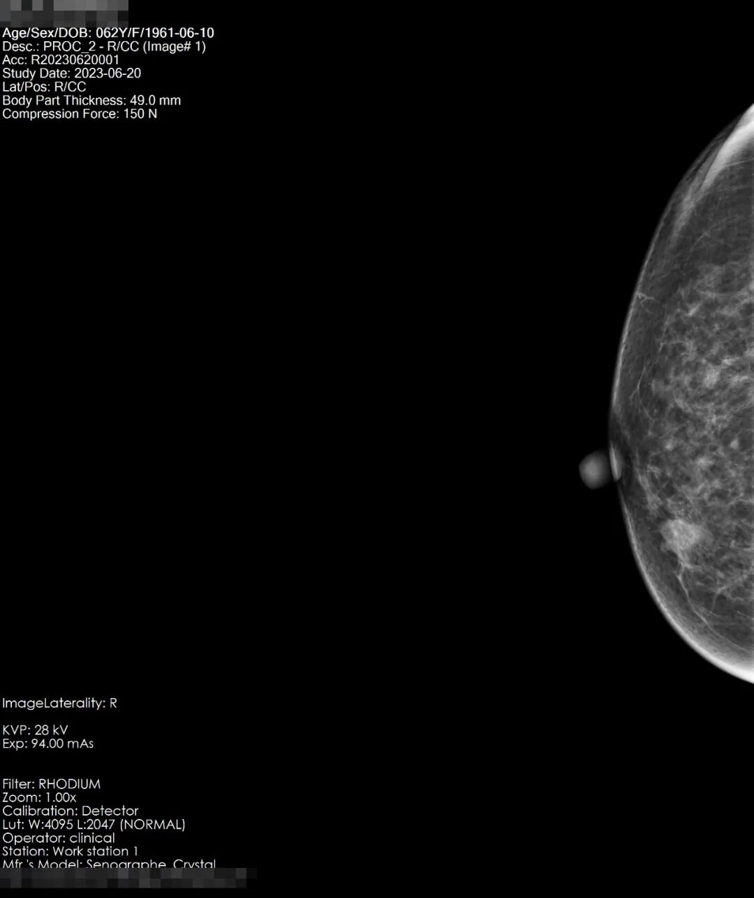 ge钼靶机怎么打印本院高端医疗设备介绍系列（四）｜ 美国GE数字化乳腺钼靶X光射线机！_https://www.jmylbn.com_新闻资讯_第5张
