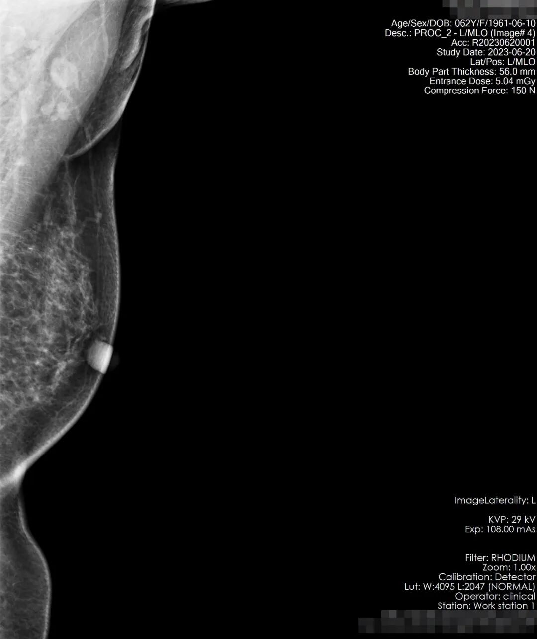 ge钼靶机怎么打印本院高端医疗设备介绍系列（四）｜ 美国GE数字化乳腺钼靶X光射线机！_https://www.jmylbn.com_新闻资讯_第8张