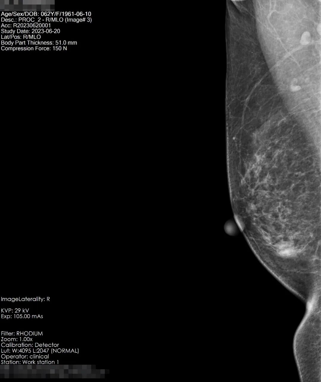ge钼靶机怎么打印本院高端医疗设备介绍系列（四）｜ 美国GE数字化乳腺钼靶X光射线机！_https://www.jmylbn.com_新闻资讯_第7张