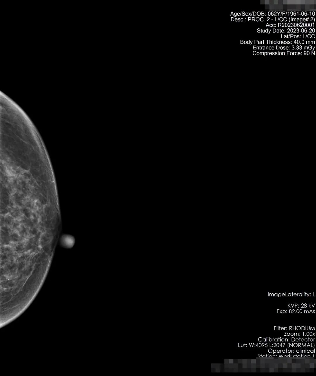 ge钼靶机怎么打印本院高端医疗设备介绍系列（四）｜ 美国GE数字化乳腺钼靶X光射线机！_https://www.jmylbn.com_新闻资讯_第6张