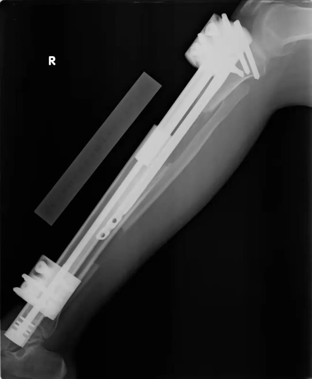 近乎自残！他们为何打断骨头求增高