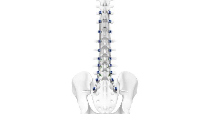 强生depuy是什么细节亮相！强生新型脊柱螺钉系统-上海聚慕医疗器械有限公司