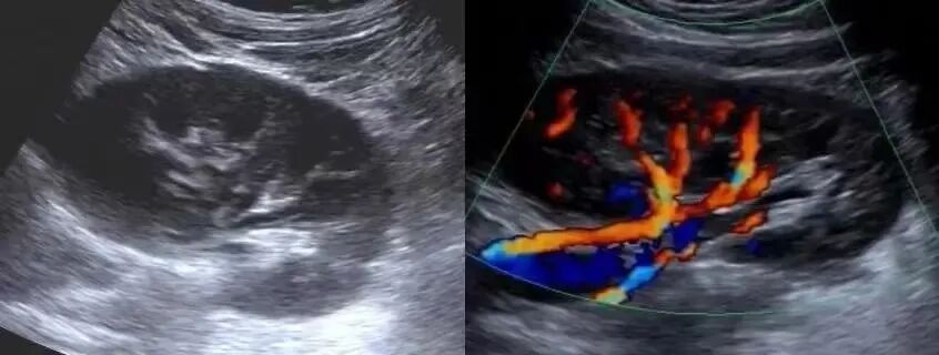 多普勒彩超图怎么看两张图带你了解一下B超与彩超区别_https://www.jmylbn.com_新闻资讯_第5张