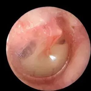 鼓膜治疗仪有什么用省直中医院耳鼻喉科新添置鼓膜治疗仪——治疗耳鸣、耳聋的“听诊器”_https://www.jmylbn.com_新闻资讯_第3张