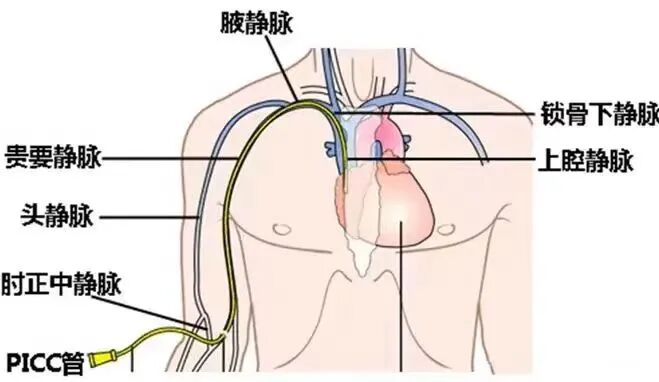 picc导管是什么材质【健康科普】PICC 护理——为＂生命导管＂护航！_https://www.jmylbn.com_新闻资讯_第5张