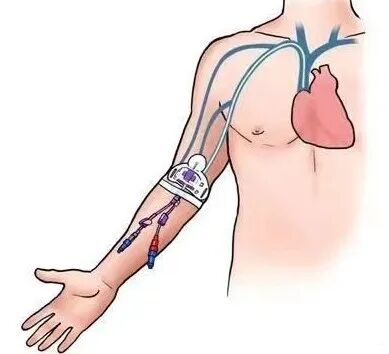 picc导管是什么材质【健康科普】PICC 护理——为＂生命导管＂护航！_https://www.jmylbn.com_新闻资讯_第6张