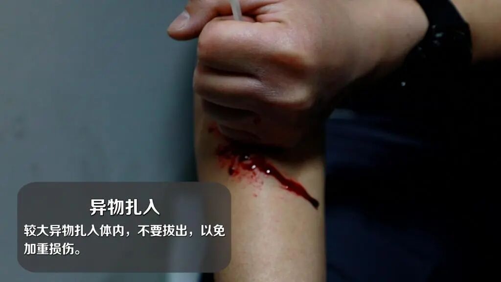 医用绷带怎么绑腹部《应急救援员》五级国家职业资格证书考试学习：外伤处理中5种绷带包扎方法、外伤止血方法及注意事项、气道异物梗阻的紧急处理等_https://www.jmylbn.com_新闻资讯_第7张