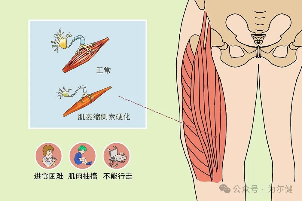 bipap是什么一文告诉你什么是渐冻症（肌萎缩侧索硬化）_https://www.jmylbn.com_新闻资讯_第1张