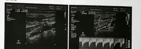 波科支架怎么样径技-弓上病例大赏｜第210期·右侧颈内动脉球囊扩张术+支架植入术_https://www.jmylbn.com_新闻资讯_第6张