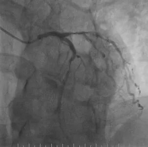 波科支架怎么样​径技·第165期｜7F经桡入路下的颈动脉狭窄支架成形术一例_https://www.jmylbn.com_新闻资讯_第19张