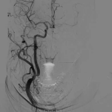 波科支架怎么样​径技·第165期｜7F经桡入路下的颈动脉狭窄支架成形术一例_https://www.jmylbn.com_新闻资讯_第8张