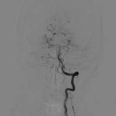 波科支架怎么样​径技·第165期｜7F经桡入路下的颈动脉狭窄支架成形术一例_https://www.jmylbn.com_新闻资讯_第16张
