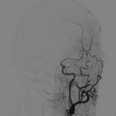 波科支架怎么样​径技·第165期｜7F经桡入路下的颈动脉狭窄支架成形术一例_https://www.jmylbn.com_新闻资讯_第13张